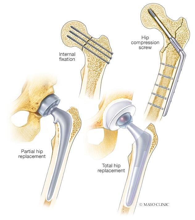 Técnicas de reparación de fracturas de cadera