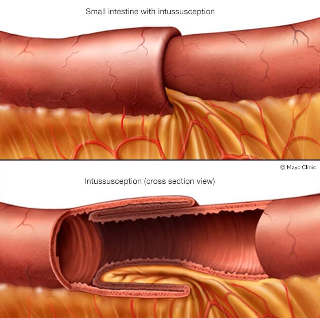 Intussusception