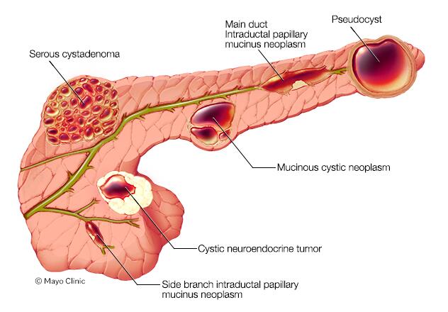 Types of pancreatic cysts 