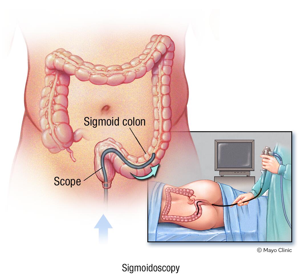 Estudio de sigmoidoscopía flexible