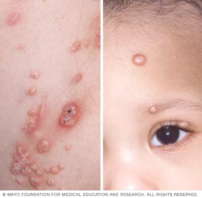 Molluscum contagiosum 