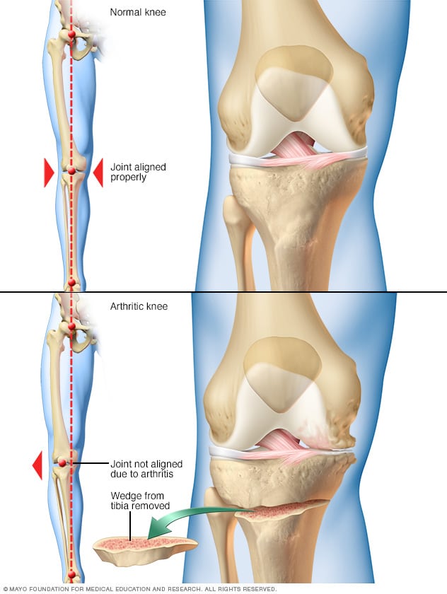 Osteotomía de rodilla 