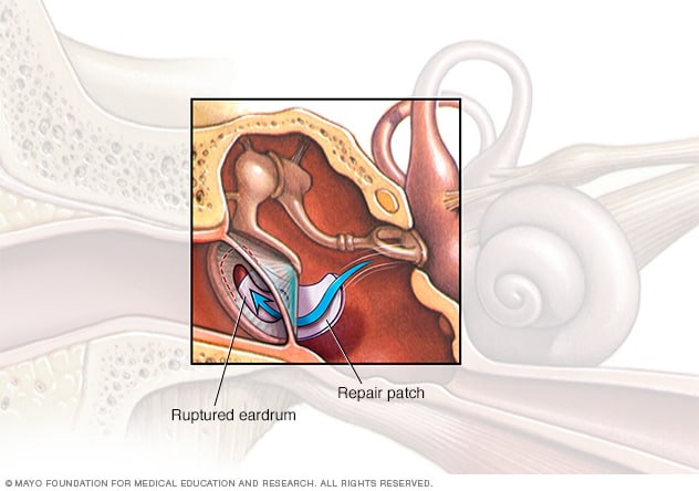 Timpanoplastia