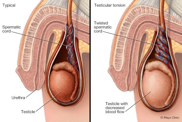 Ilustración de un pene antes y durante la torsión testicular