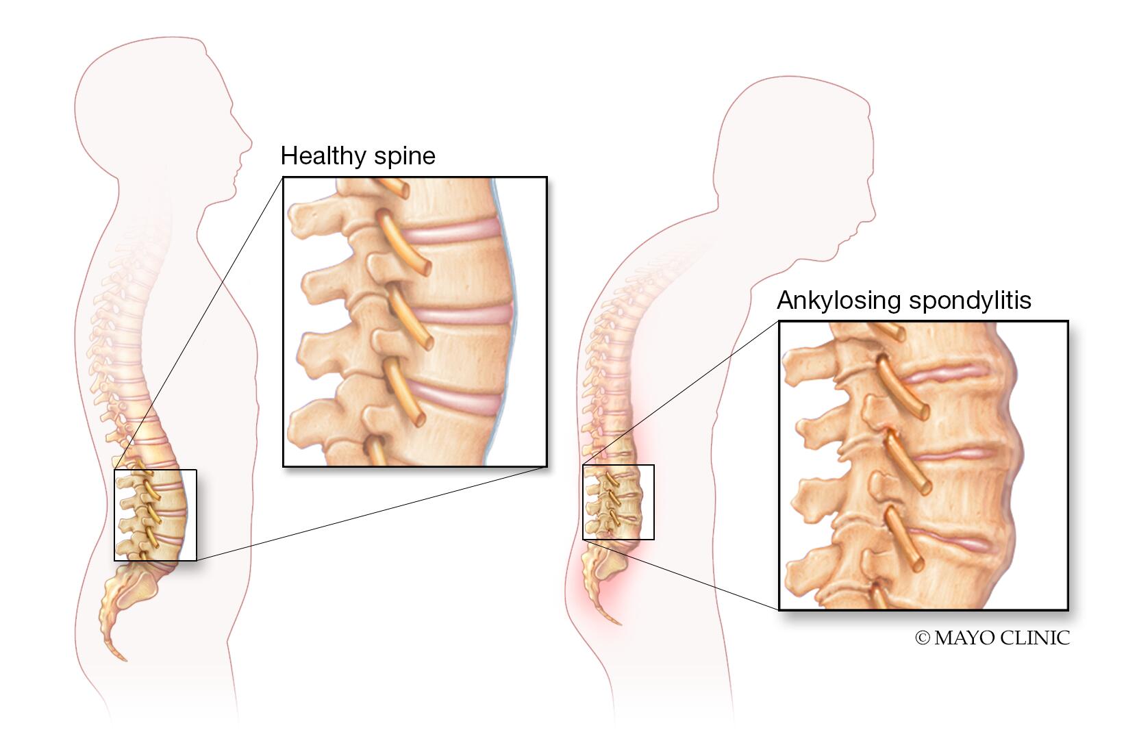 Cambios de la columna vertebral en la espondilitis anquilosante