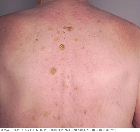 Seborrheic keratoses on the back 