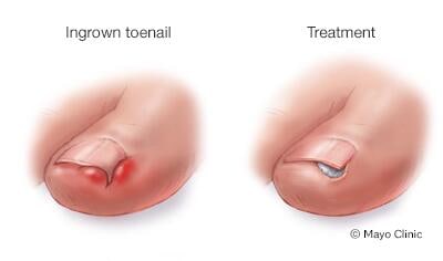 Ingrown toenail treatment