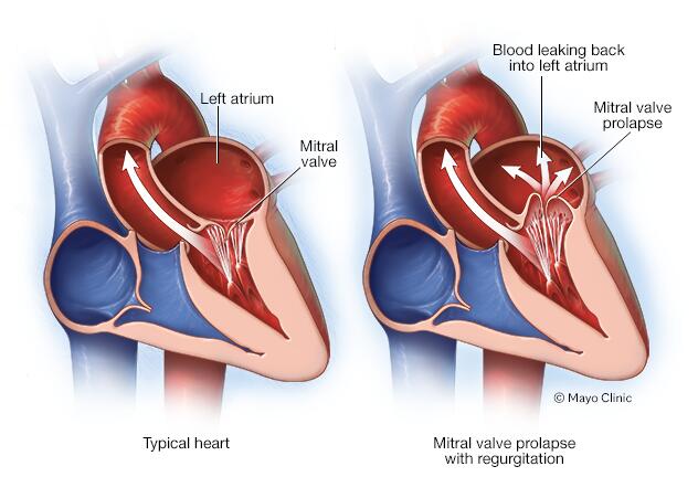 Heart showing mitral valve prolapse and regurgitation