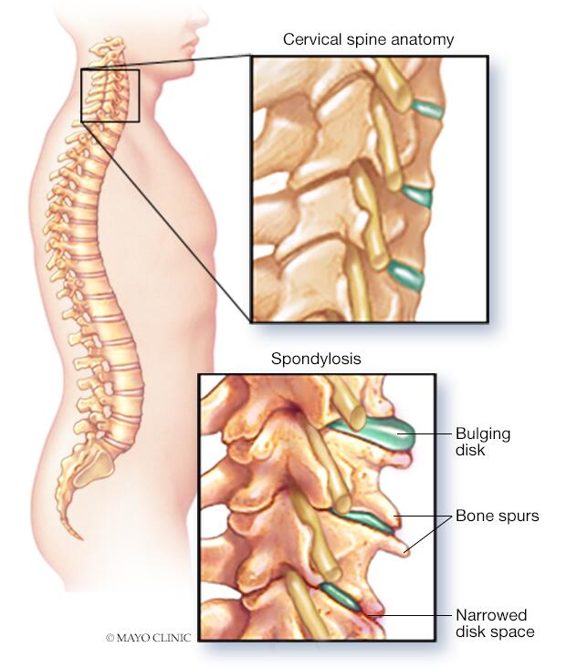 Cervical spondylosis