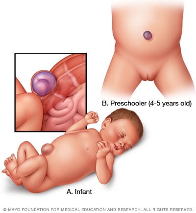 Umbilical hernia