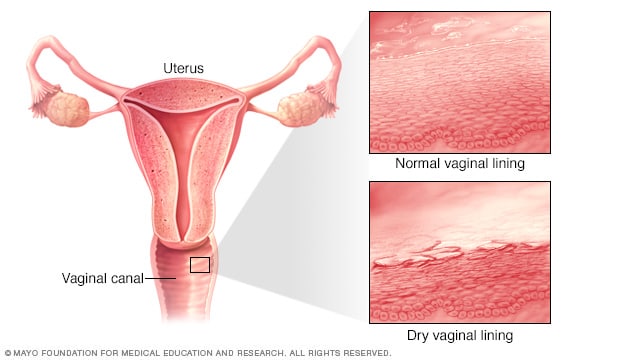 Atrofia vaginal // Middlesex Health