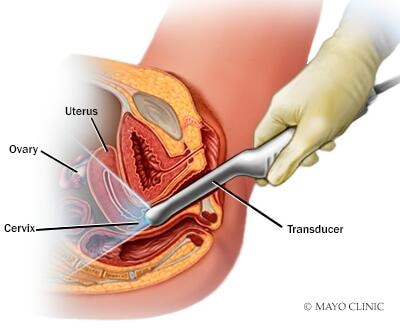 Transvaginal ultrasound