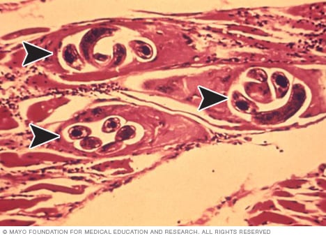 Vista microscópica de larvas de Trichinella en el tejido muscular