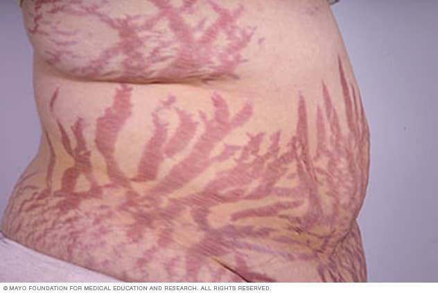 Widespread stretch marks