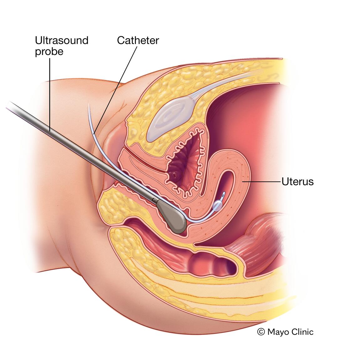 Hysterosonography