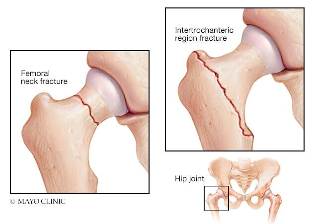 The two most common types of hip fractures