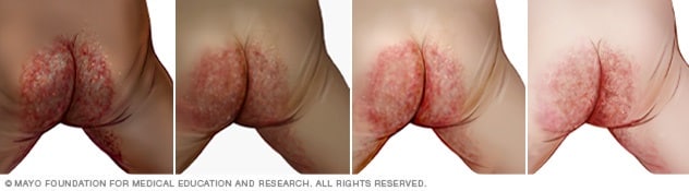 La dermatitis del pañal suele aparecer en los glúteos, los muslos y el área genital.