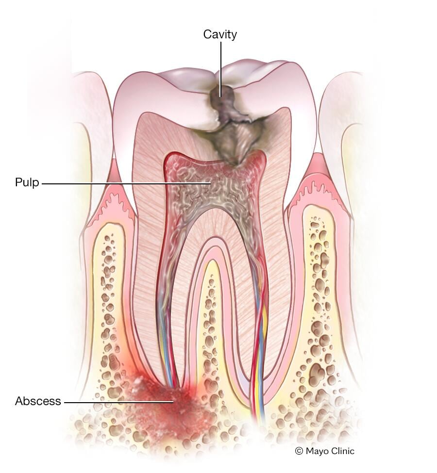 Periapical tooth abscess