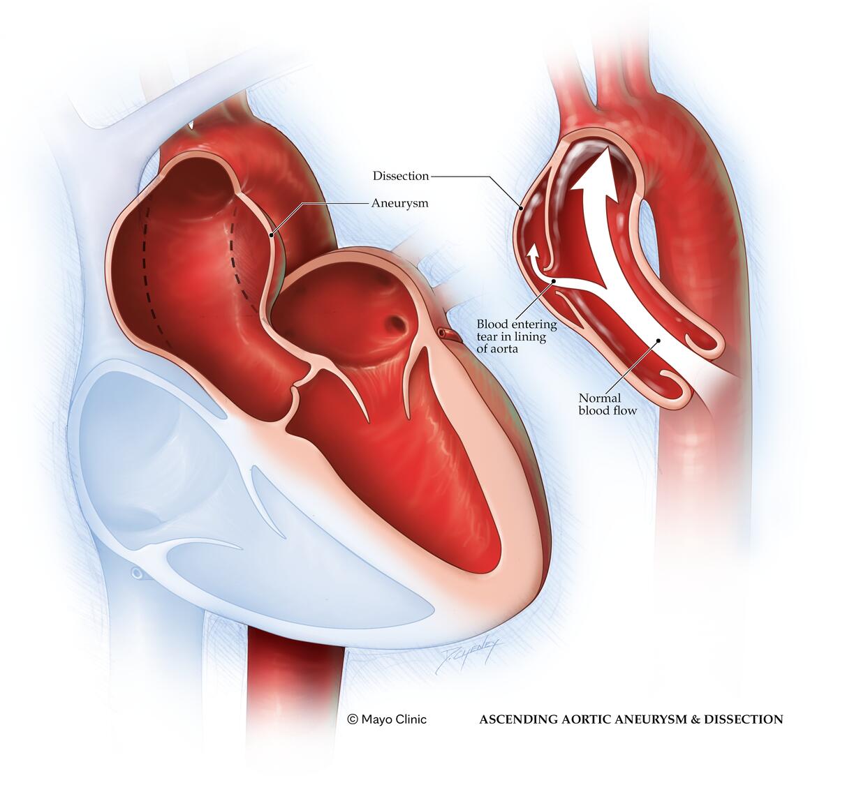 Aortic aneurysm and dissection