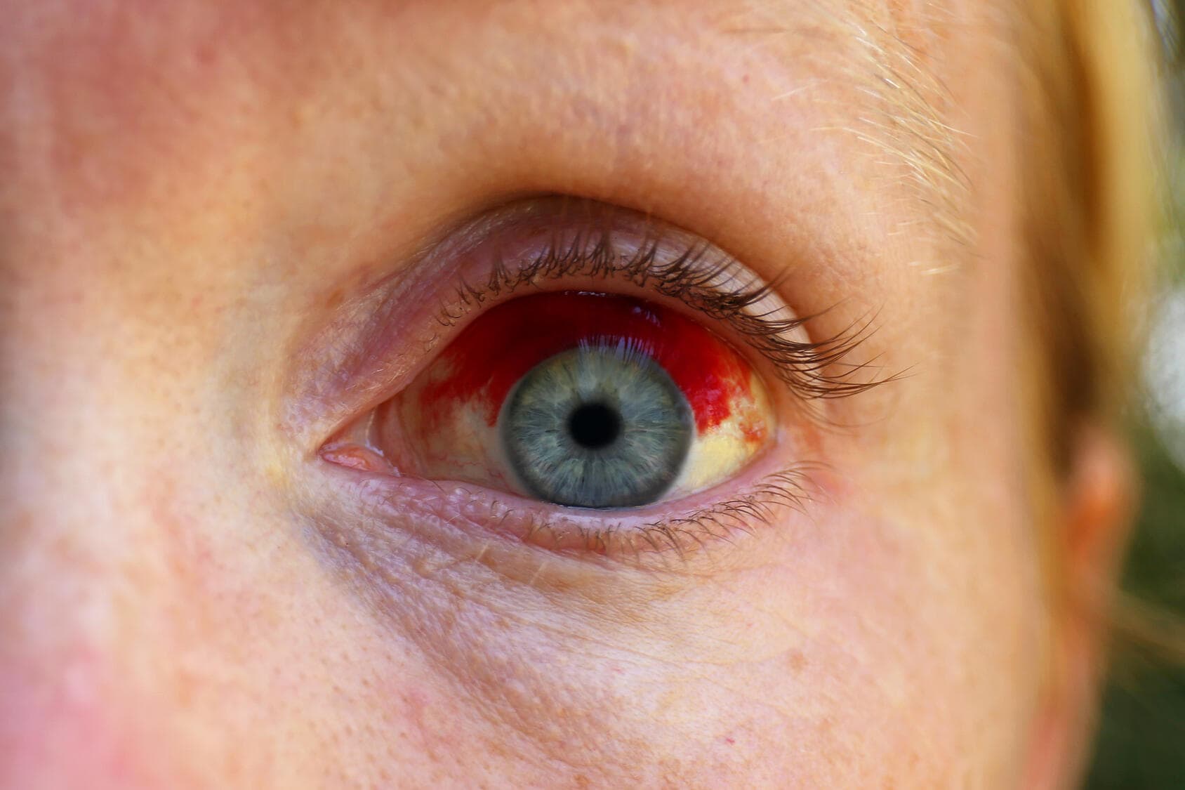 Image showing a broken blood vessel in the eye