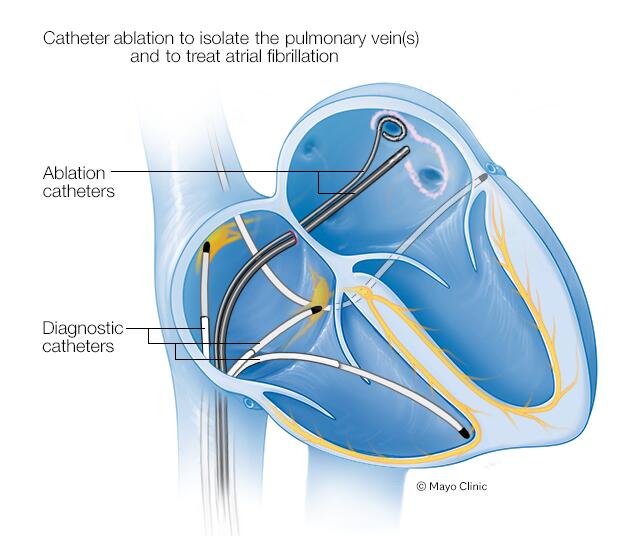 Ubicación de los catéteres para el aislamiento de las venas pulmonares