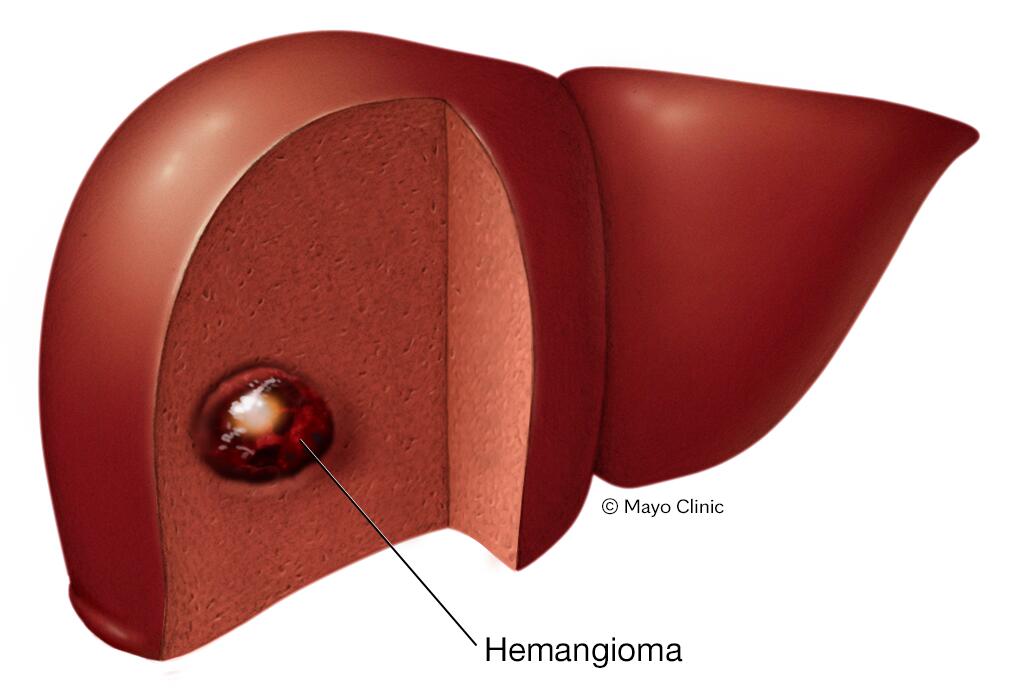 Liver hemangioma