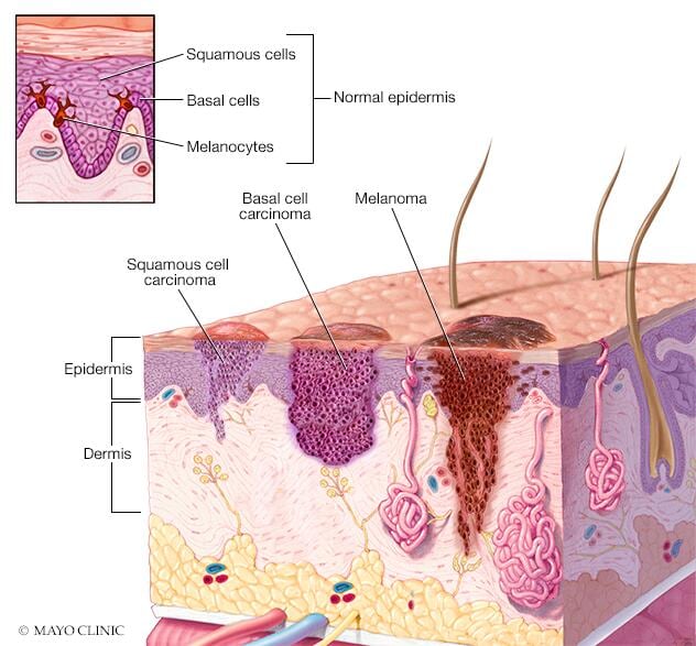 Dónde se desarrolla el cáncer de piel 