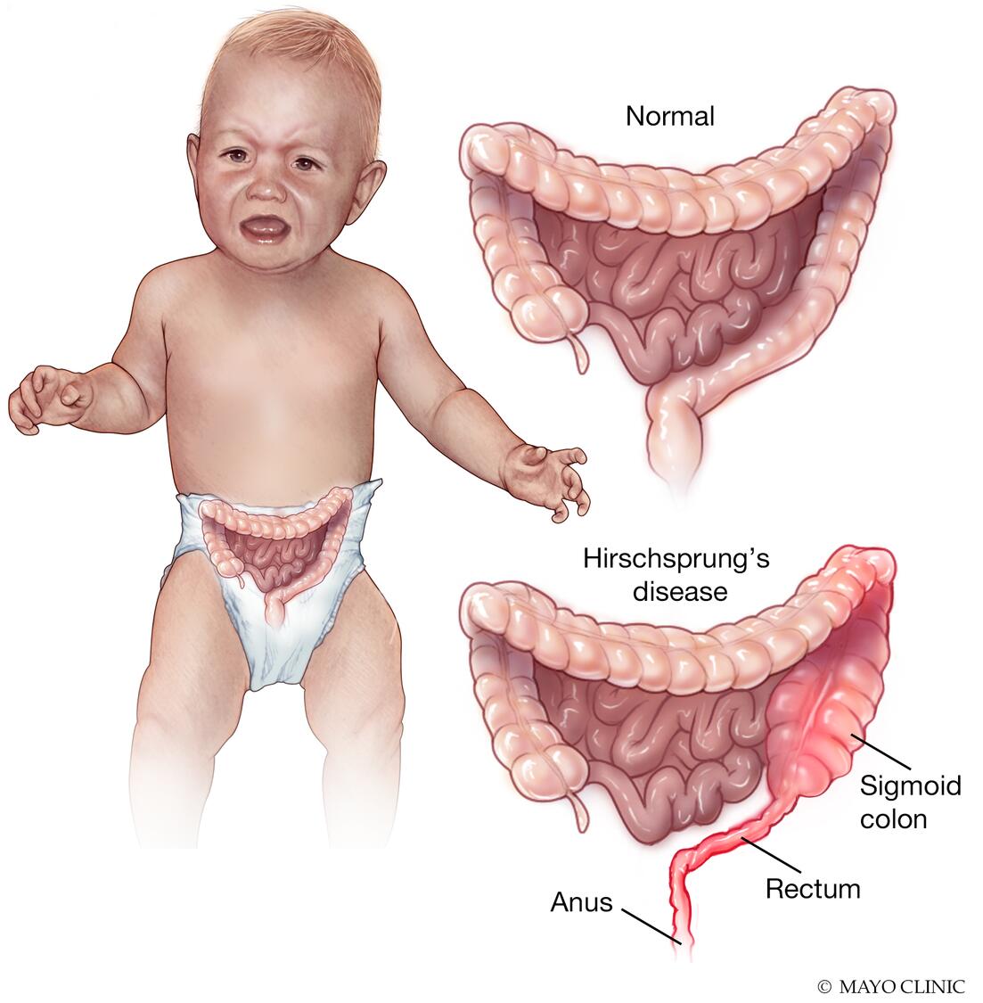 Ilustración que muestra colon y recto normales y con enfermedad de Hirschsprung