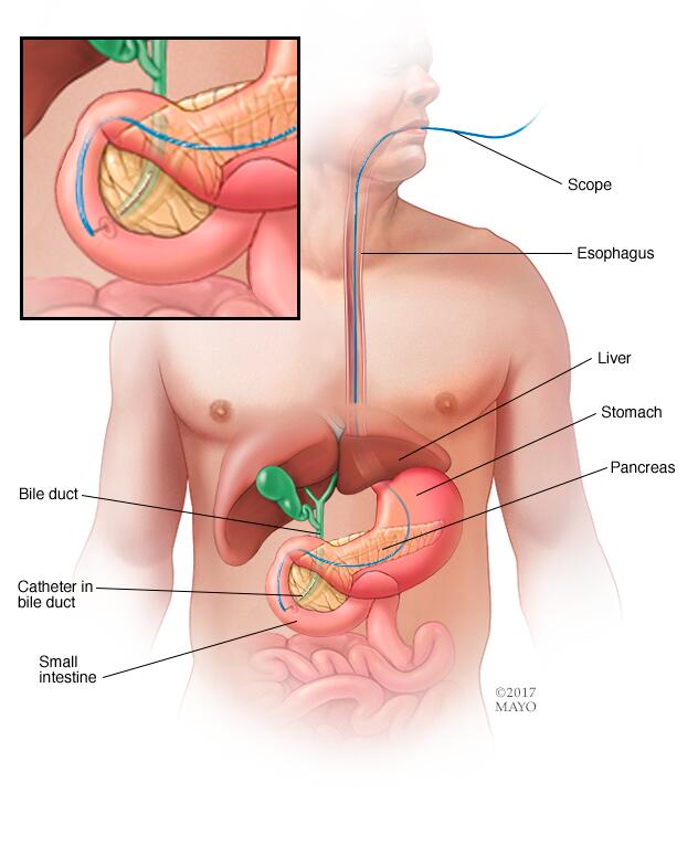 Procedimiento de colangiopancreatografía retrógrada endoscópica