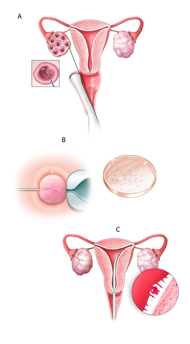 In vitro fertilization process