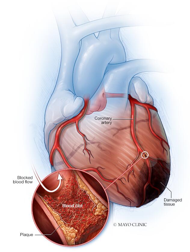 does chewing tobacco cause plaque in arteries Heart attack // Middlesex Health What is Atherosclerosis (Hardening of