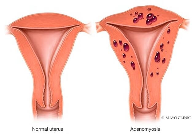 Útero normal y útero con adenomiosis