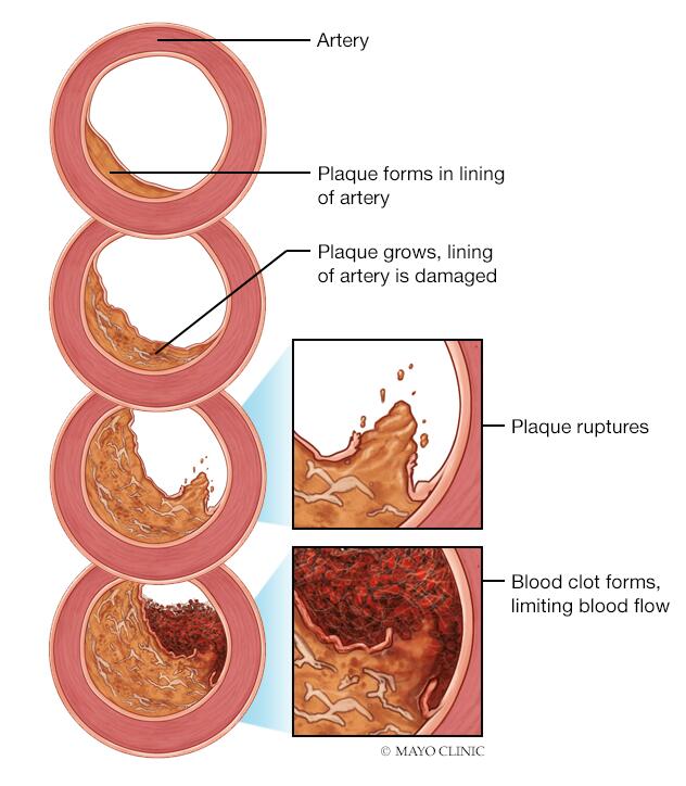 Development of atherosclerosis