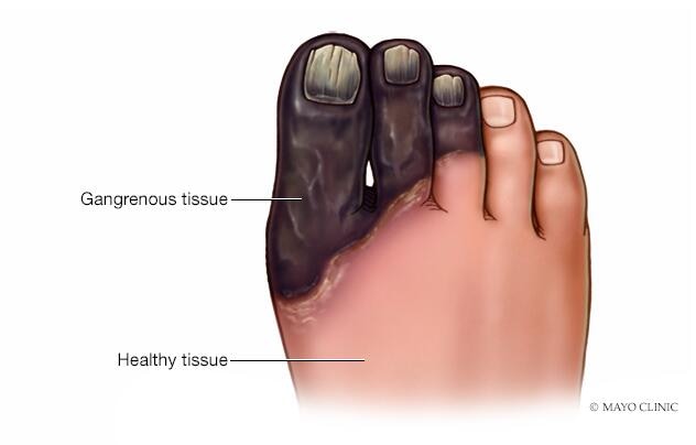 Gangrene of the foot