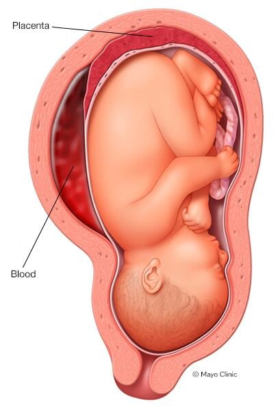 Desprendimiento de placenta 