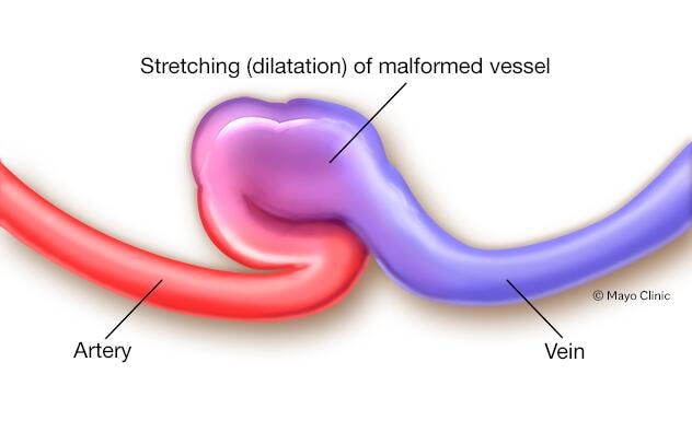 Arteriovenous fistula