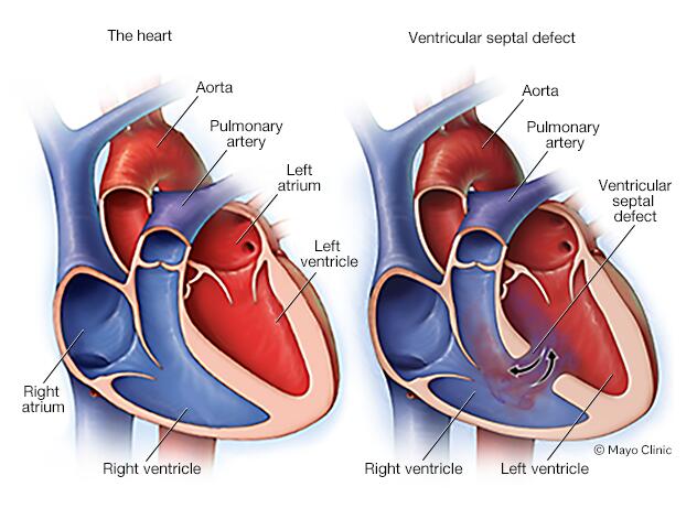 Ventricular septal defect