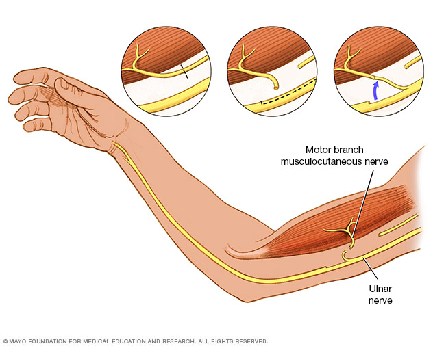 A nerve transfer