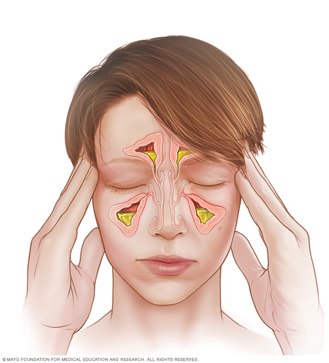 Sinusitis aguda