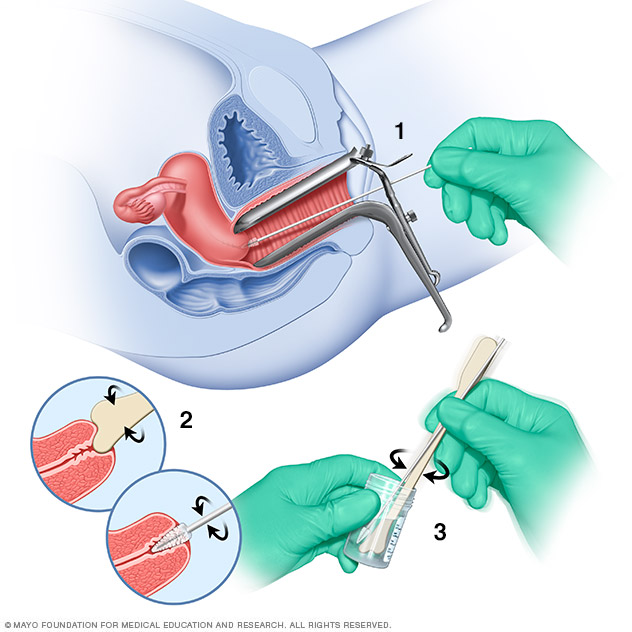 Citología vaginal