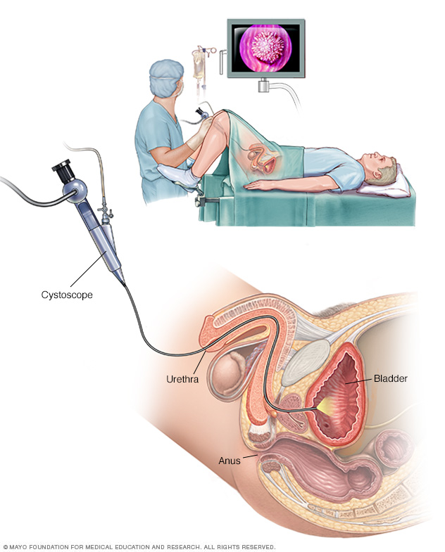 Cystoscopy performed on a man