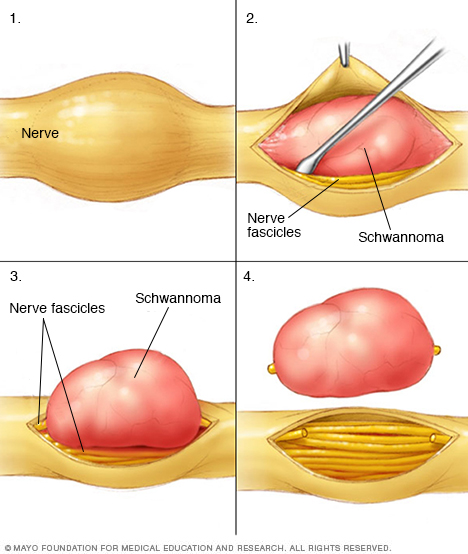 Schwannoma being removed