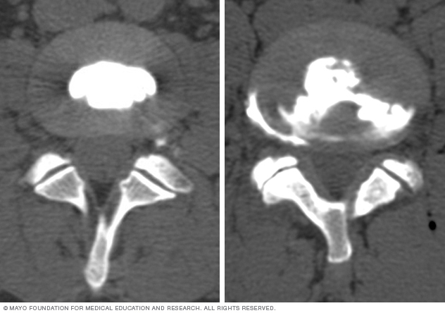 Images comparing how dye looks in normal and damaged spinal disks. 
