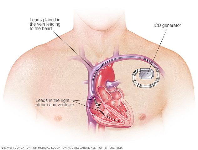 Desfibrilador cardioversor implantable