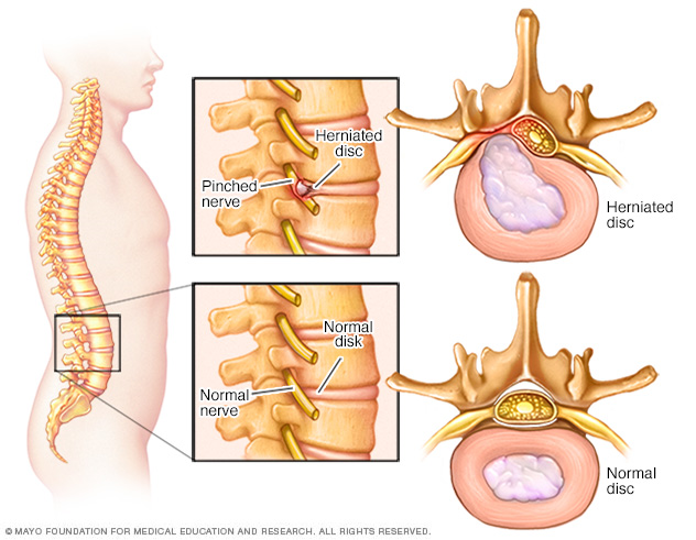 Image showing pinched nerve in spine