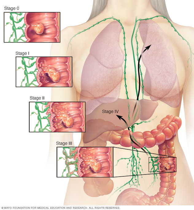 Etapas del cáncer de colon 