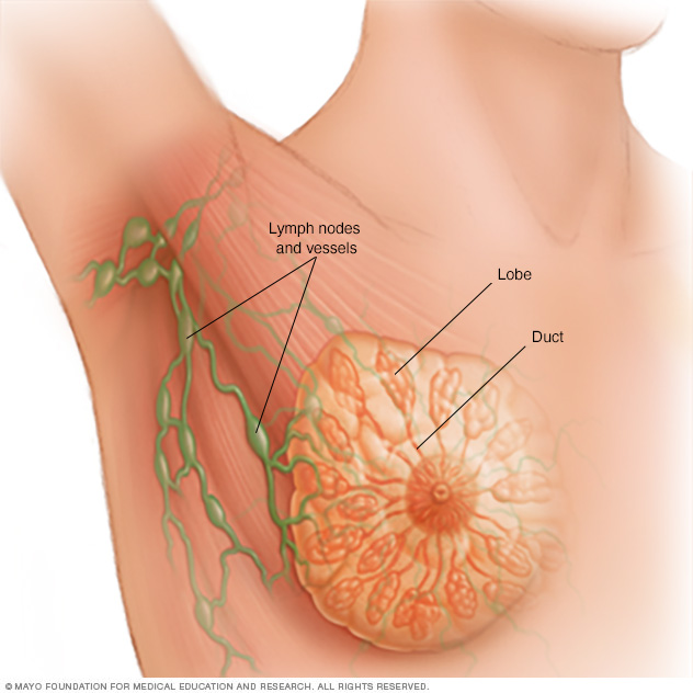 Definition of intraductal breast carcinoma - NCI Dictionary of