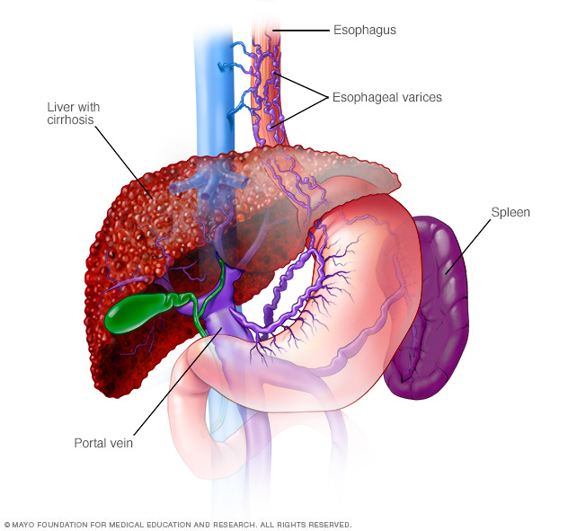 Varices esofágicas