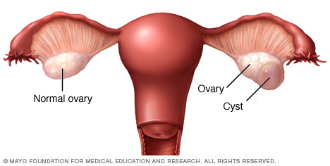 Ooforectomía (extirpación quirúrgica de los ovarios) // Middlesex Health