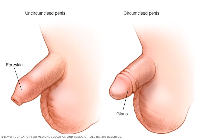  Illustration des Penis vor und nach der Beschneidung 